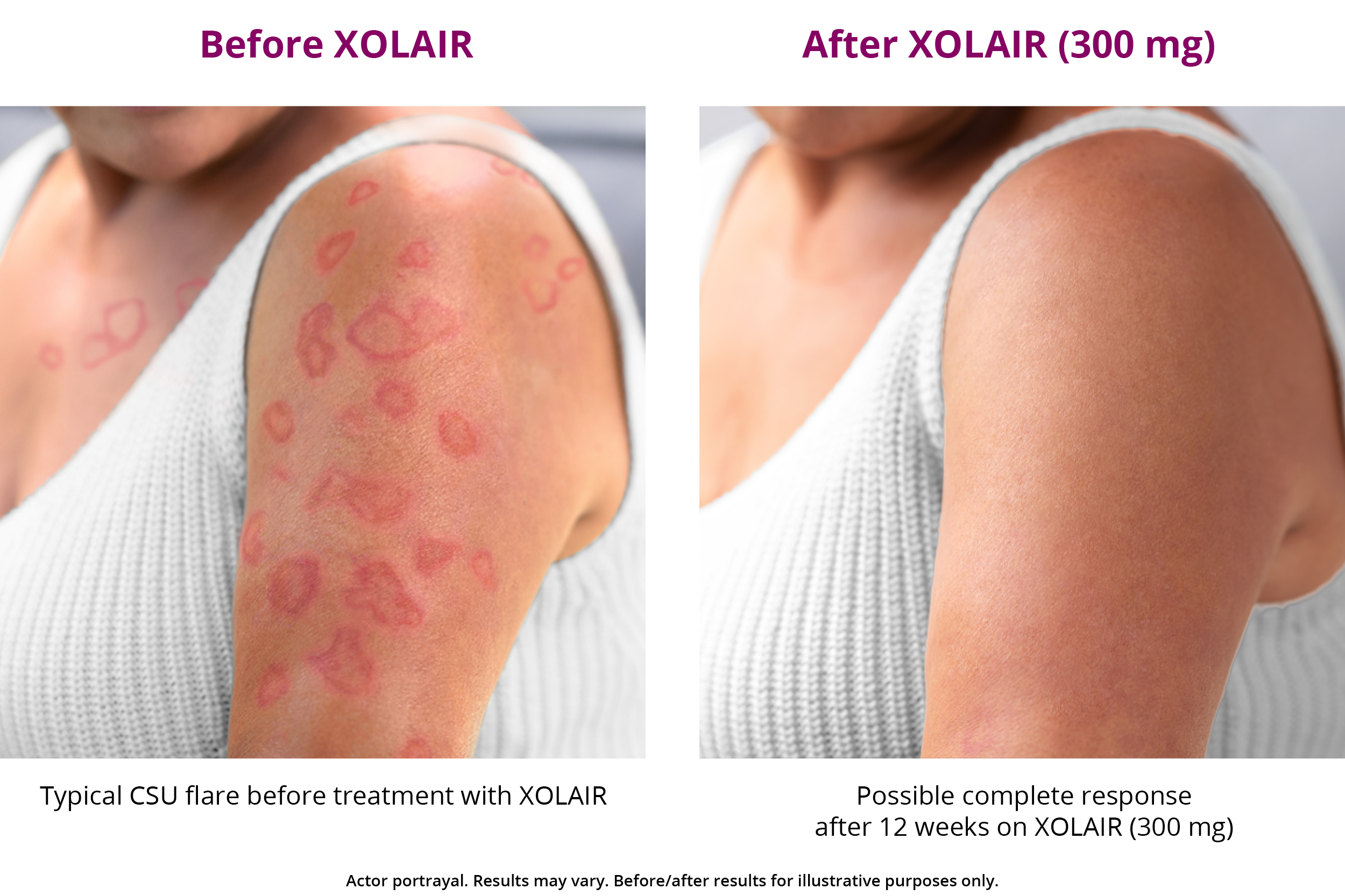 XOLAIR CSU Treatment Results XOLAIR omalizumab 
